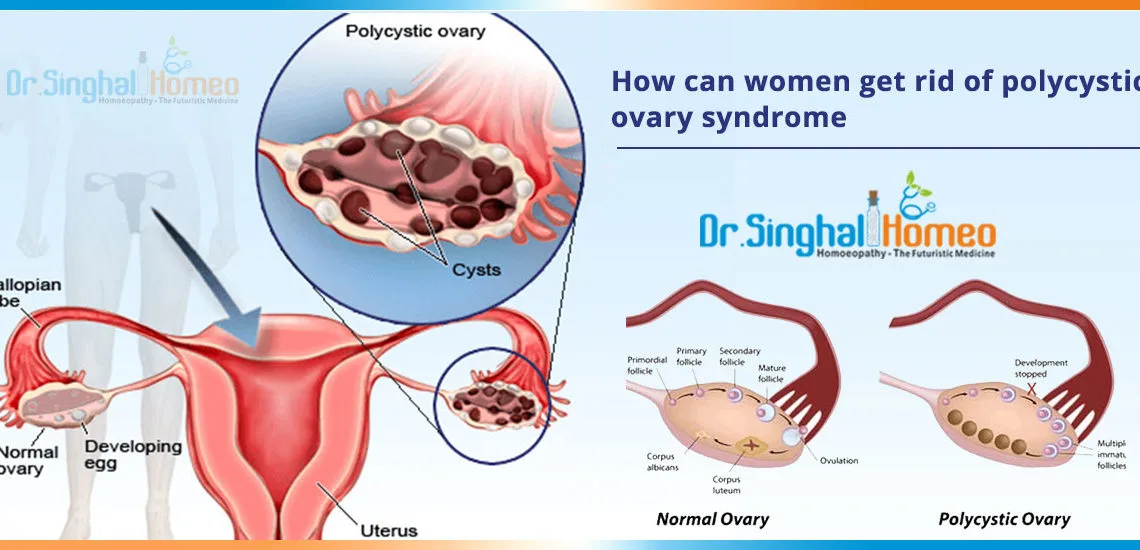 How-can-women-get-rid-of-polycystic-ovary-syndrome