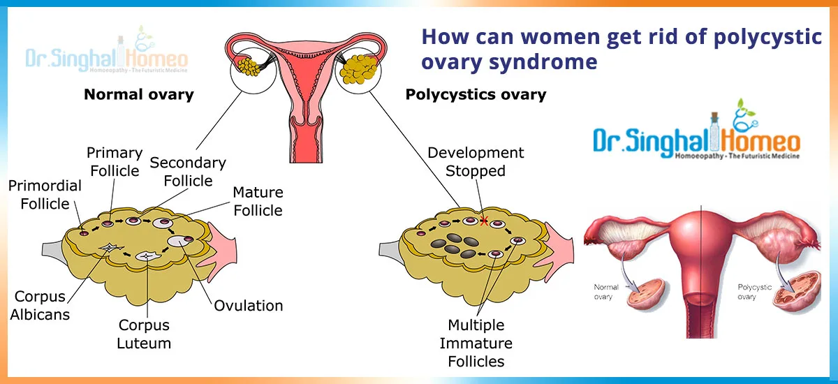 Homeopathy,IBS,Lichen Planus,Sex problem,Infertility,Dr.Singhal Homeo,Natural Cure,Asthma,Skin Specialist,Homeopathy Medicine,Homeodoctor