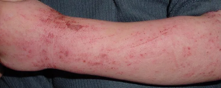 Eczema