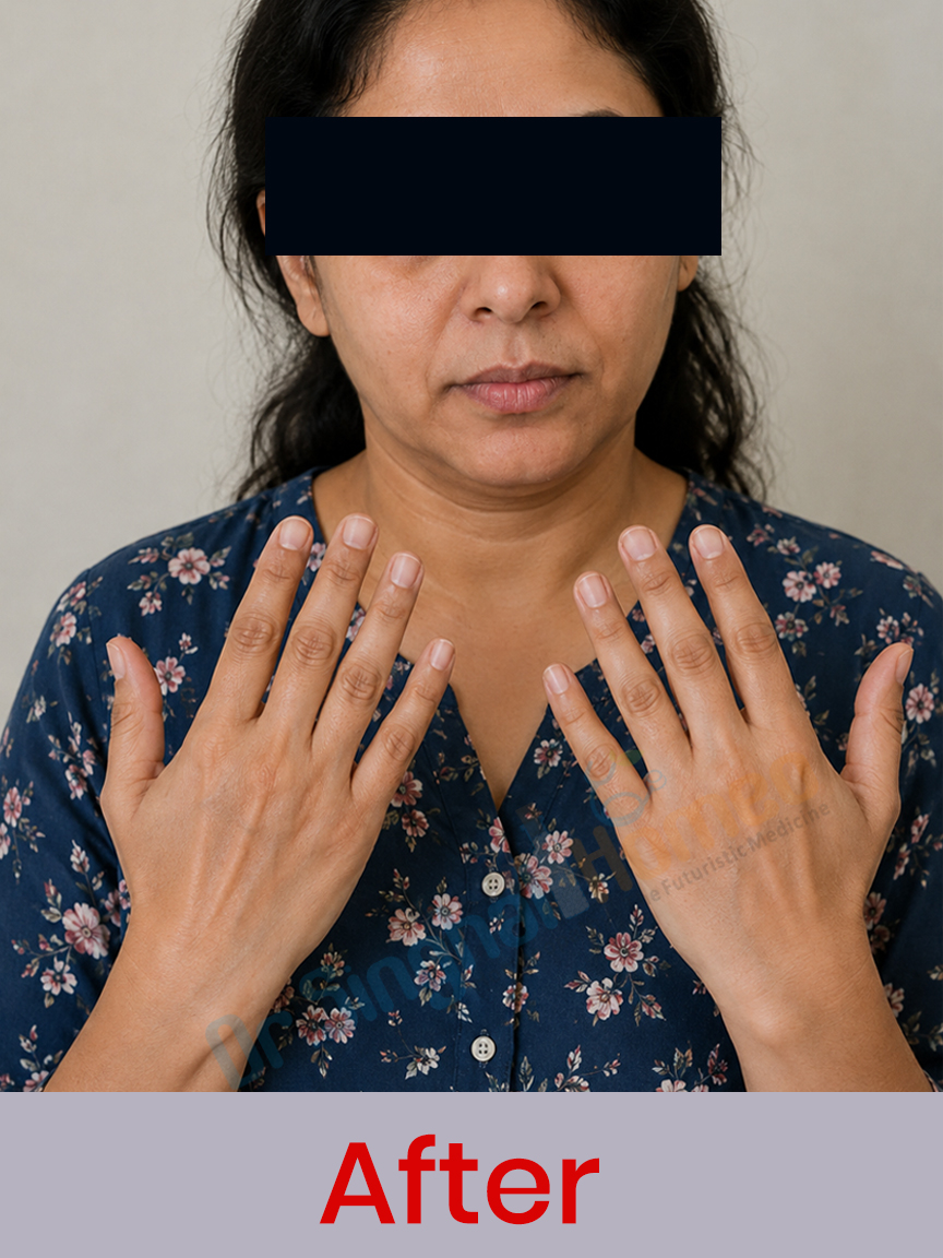 leucoderma after homeopathic treatment